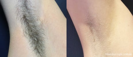 Hairy and Hairless Underarms